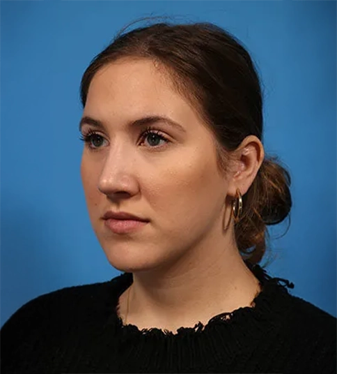 Patient after rhinoplasty showing refined nose and balanced facial profile.