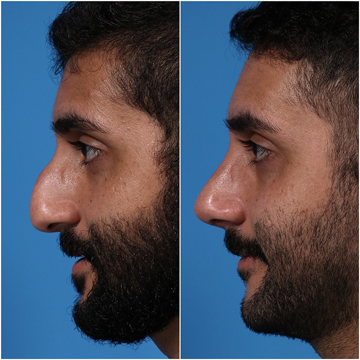 Male Plastic Surgery side 2