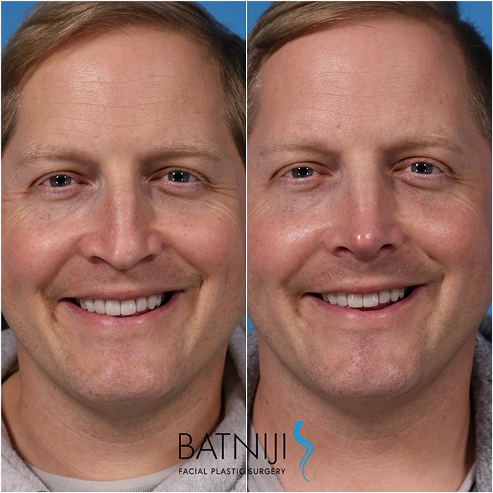 Rhinoplasty Before and After