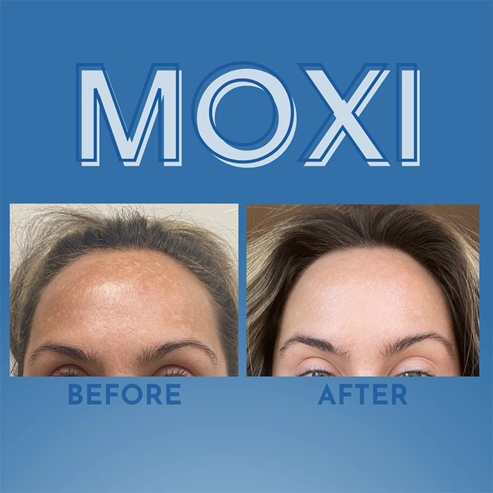 Moxi side 3 Moxi side 3
