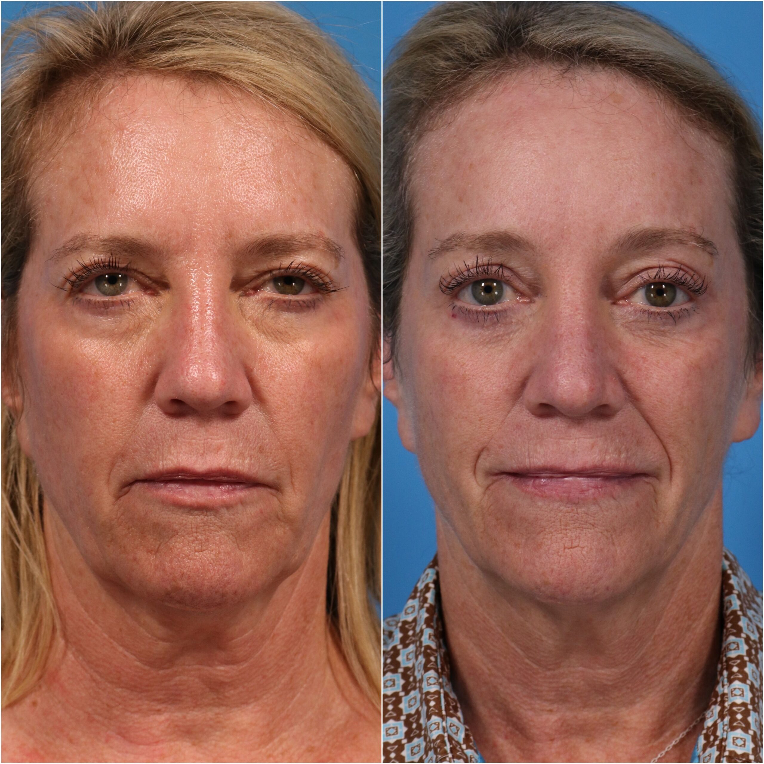 blepharoplasty blepharoplasty