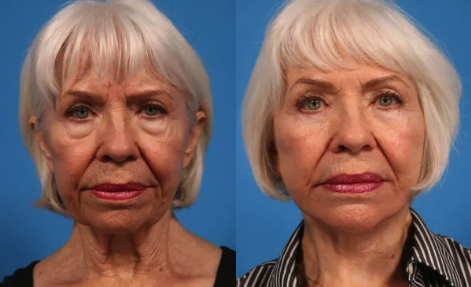 A woman shows her face before and after a facial lift.