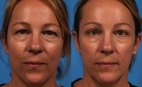 Upper Eyelid Surgery Before and After
