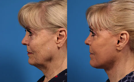 Before and after images of a woman showcasing the results of a neck lift procedure