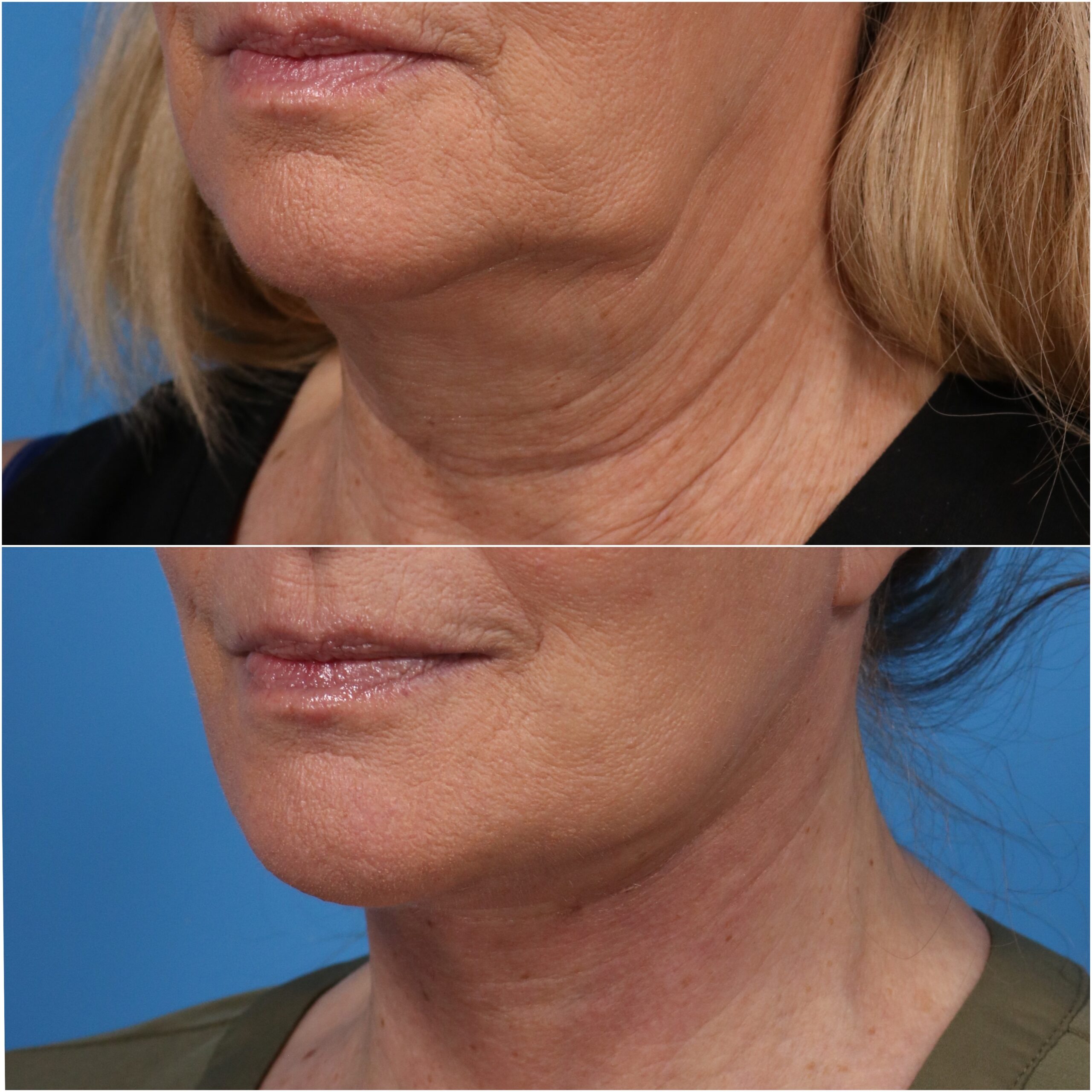 diag half face neck lift