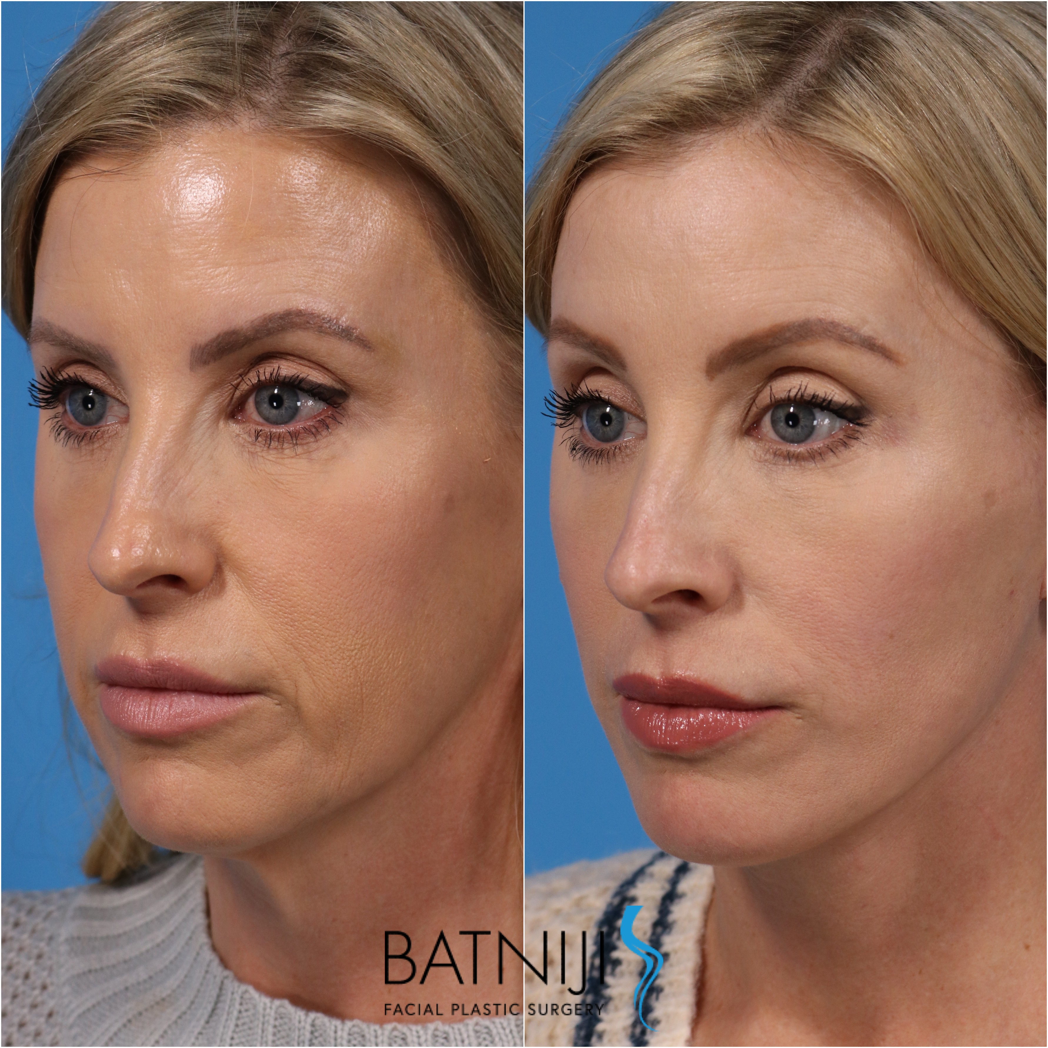 facelift, neck lift and brow lift