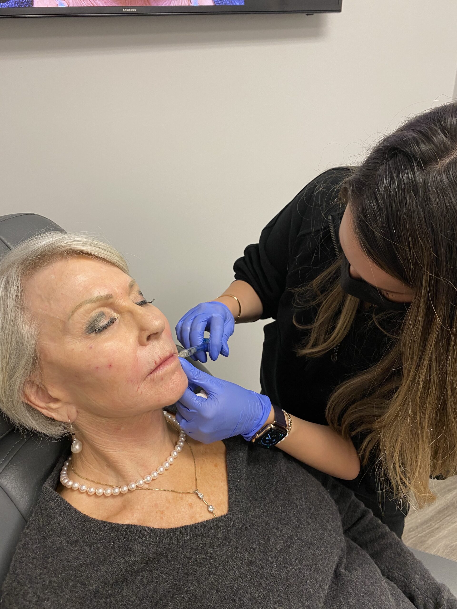 lip fillers lip fillers