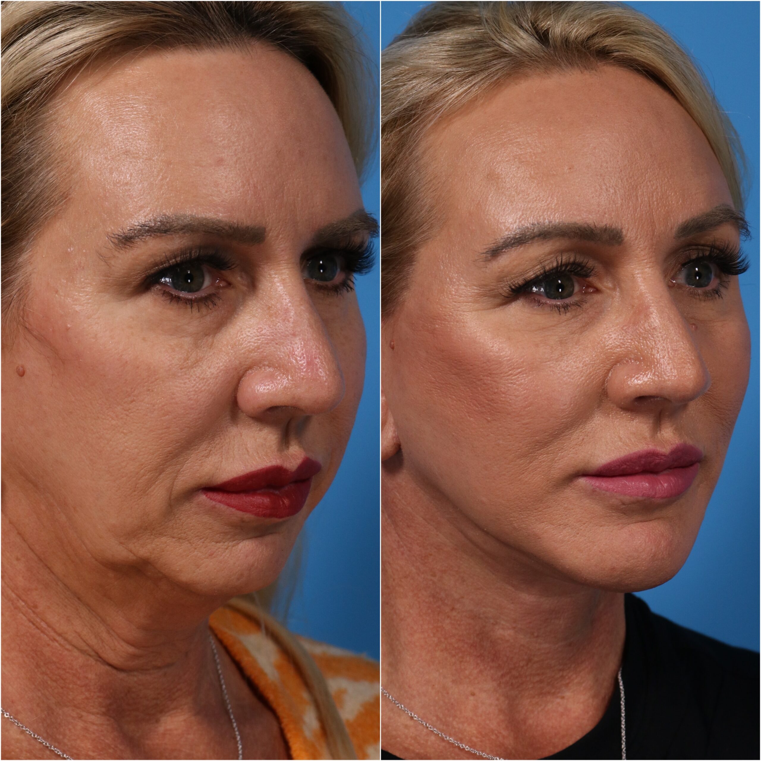neck lift jawline contouring neck lift jawline contouring
