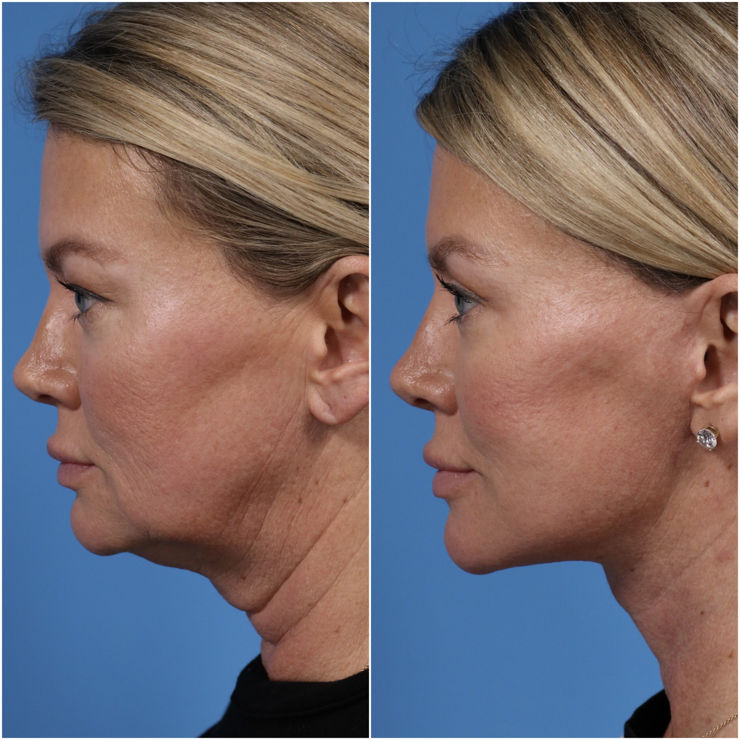 neck lift neck lift