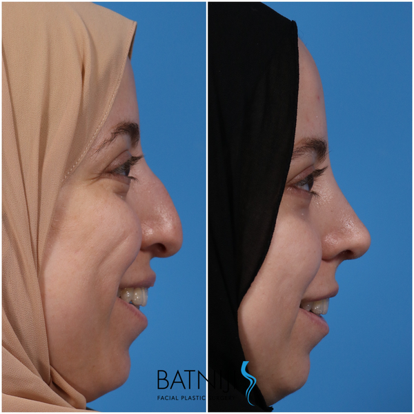 westernization rhinoplasty westernization rhinoplasty