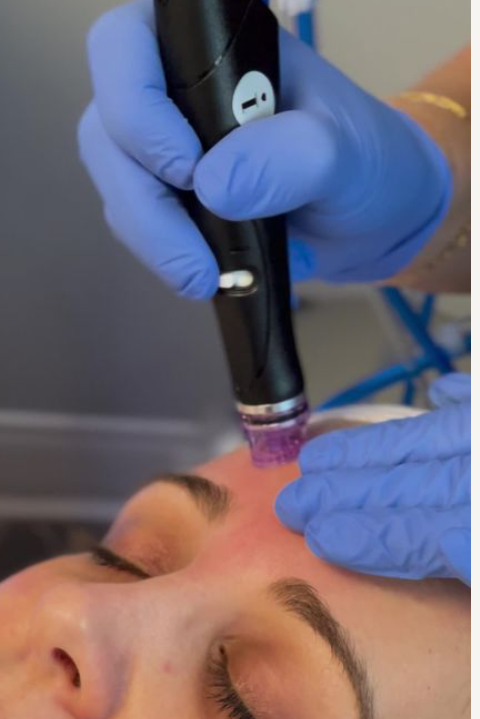hydrafacial forehead hydrafacial forehead