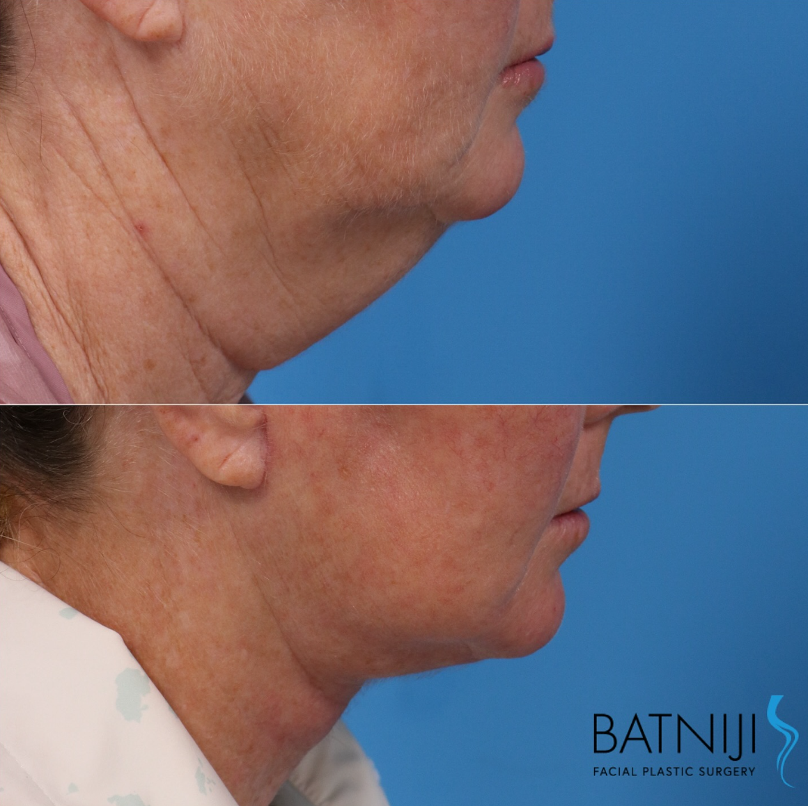 Newport Beach patient underwent a neck lift with Dr. Rami Batniji. Showing before and after the surgery.