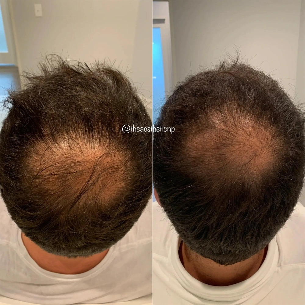 hair-restoration-male-bald-spot-1.webp