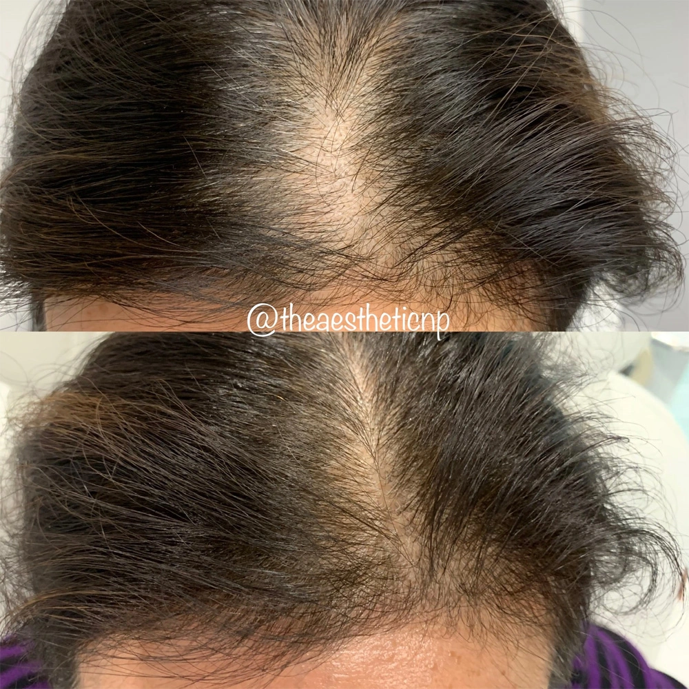 hair-restoration-newport-beach.webp