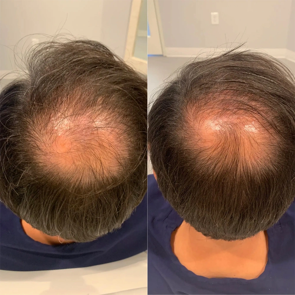 male-hair-restoration-1.webp