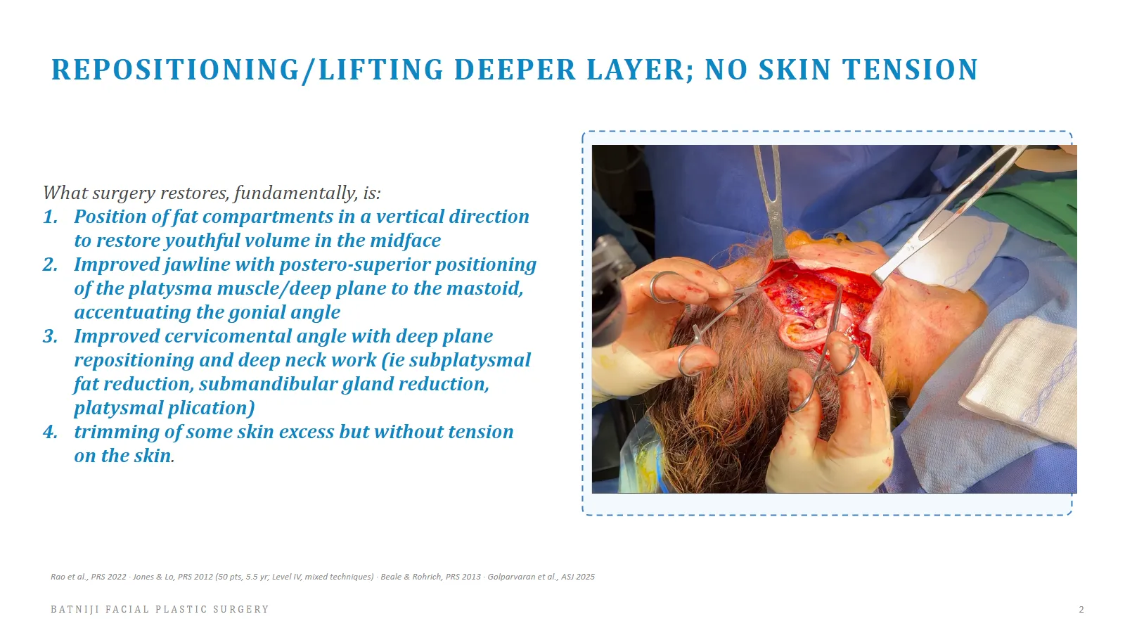 Tension-Free Deep Plane Facelift, Subplatysmal Neck Lift Newport Beach, Deep Plane Facelift Jawline Definition
