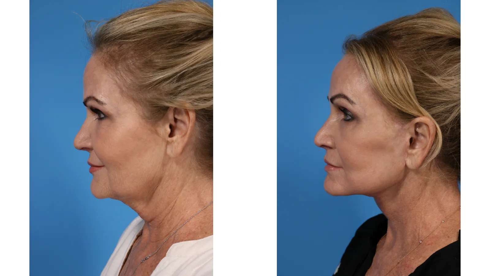Deep Plane Facelift Before and After, Deep Plane Neck Lift Results Newport Beach, Submandibular Gland Reduction Facelift