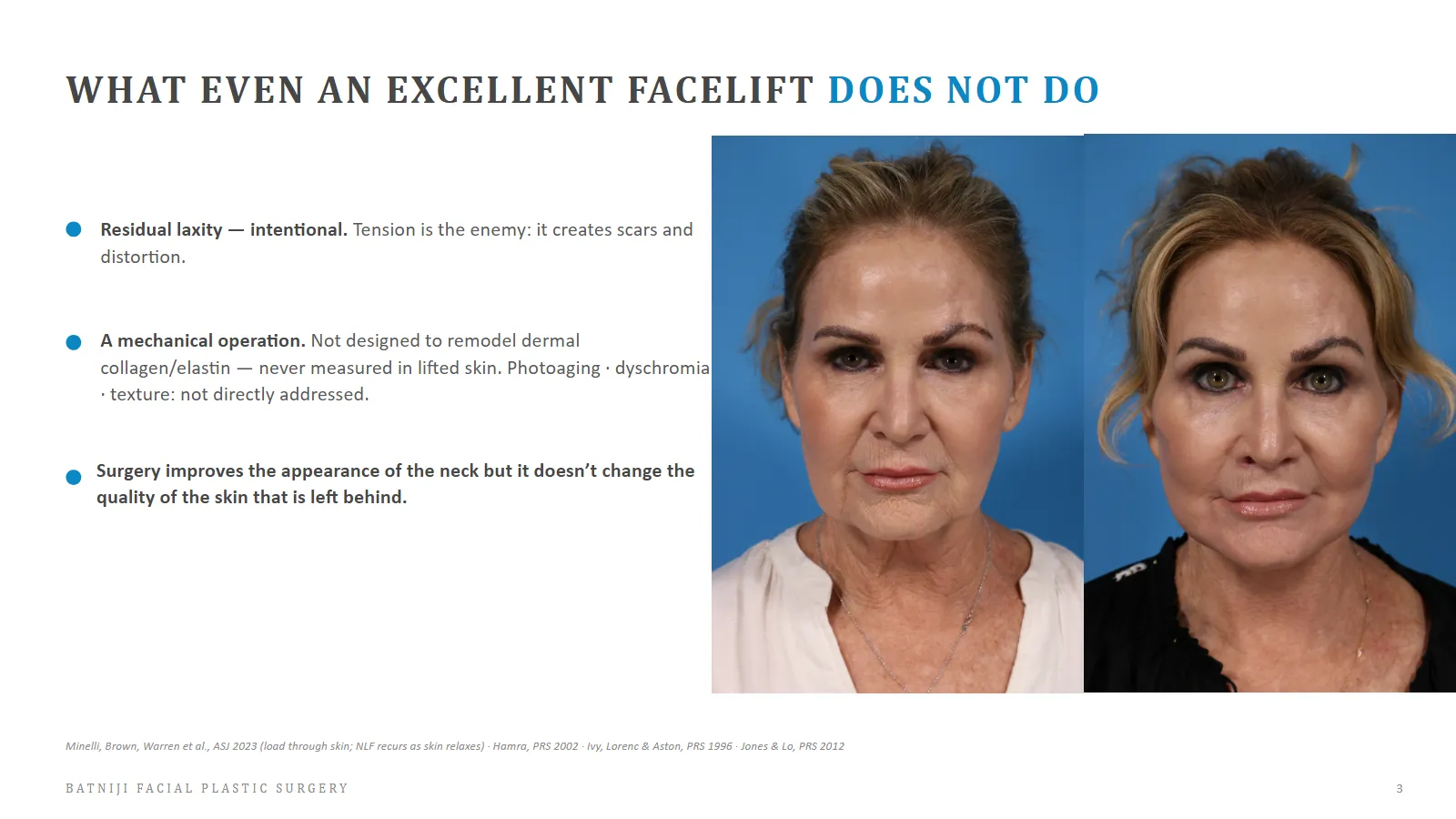 What facelift cannot fix, deep plane facelift limitations, facelift vs skin quality, facelift residual skin laxity.