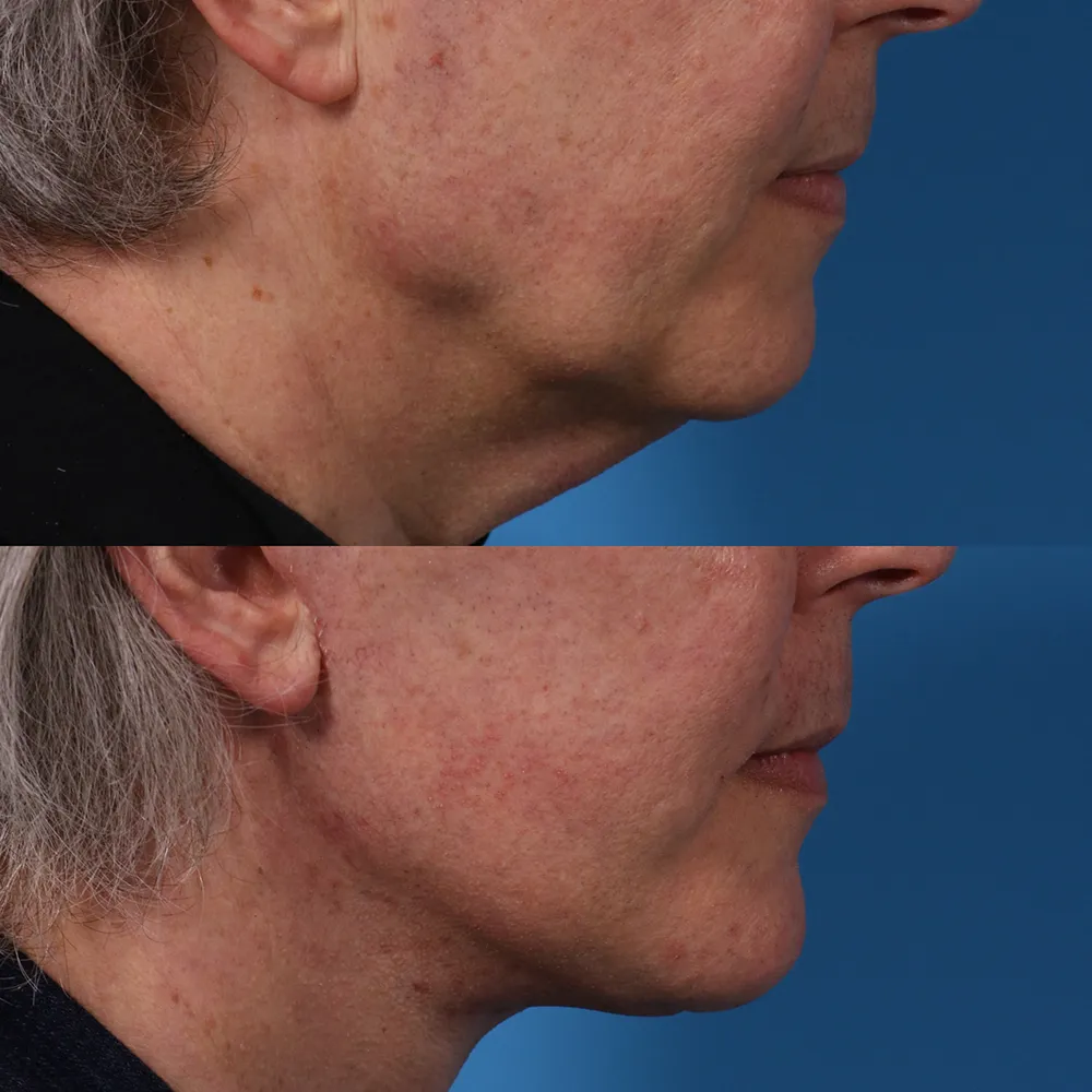 facelift_01_02