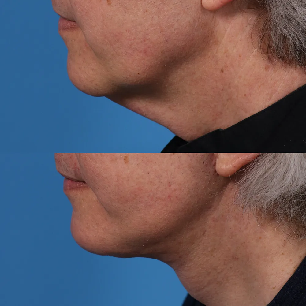 facelift_01_03