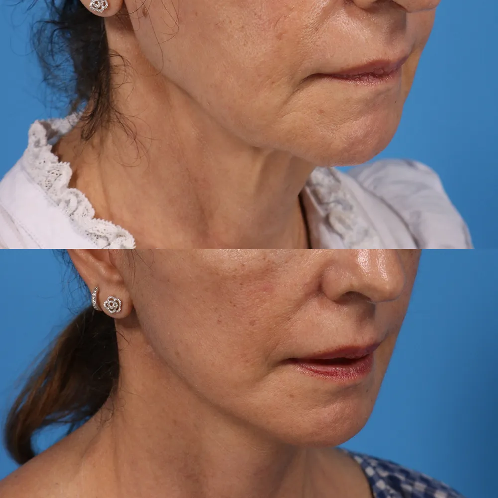 facelift_02_01