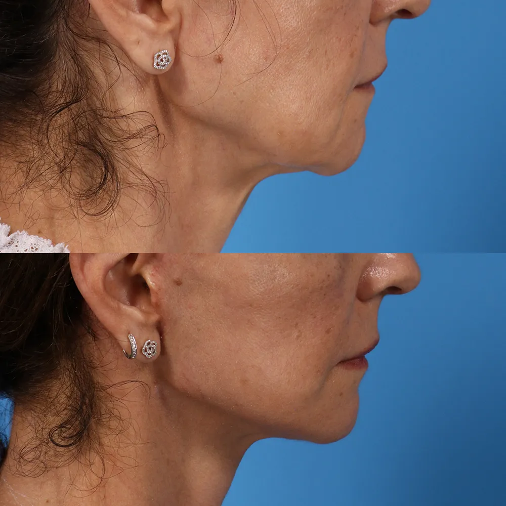 facelift_02_02
